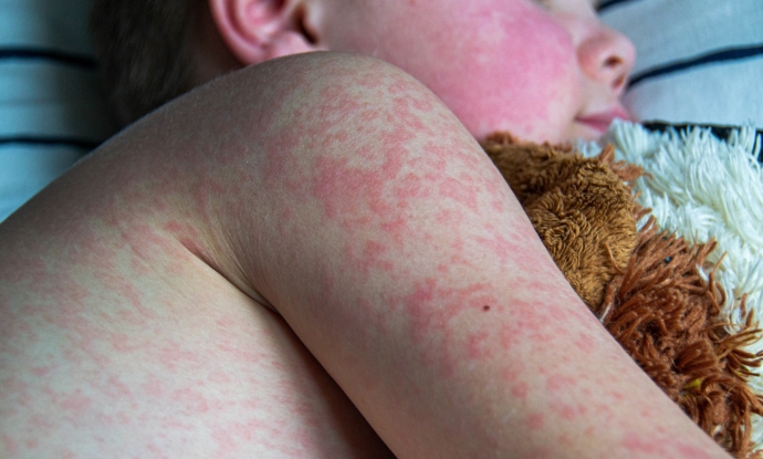 A young child with measles rash all over their body lies in bed and hugs a teddy bear.